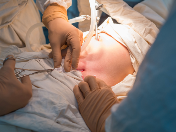 Adjustable Gastric Banding